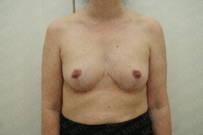 Breast Reduction Before & After Patient #4181