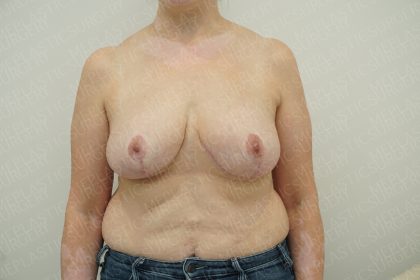 Breast Reduction Before & After Patient #4186