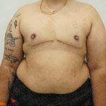 Chest Masculinization Surgery Before & After Patient #4224