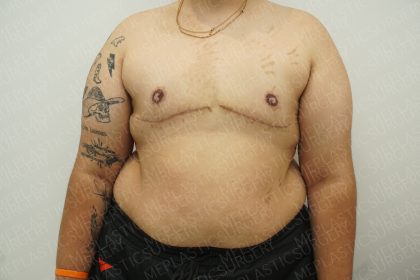Chest Masculinization Surgery Before & After Patient #4224