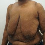 Breast Reduction Before & After Patient #4184
