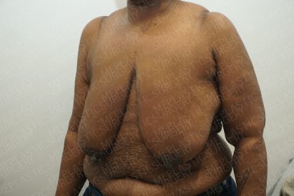 Breast Reduction Before & After Patient #4184