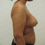 Breast Reduction Before & After Patient #4183