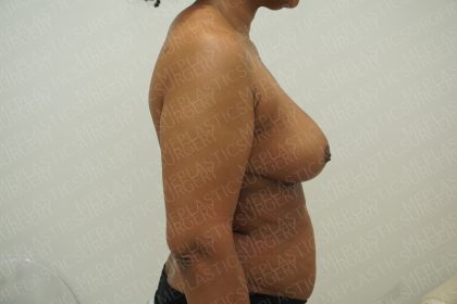 Breast Reduction Before & After Patient #4183