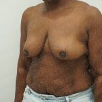 Breast Reduction Before & After Patient #4184
