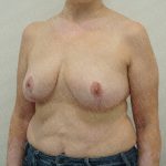 Breast Reduction Before & After Patient #4186