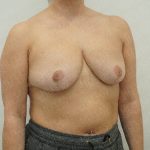 Breast Reduction Before & After Patient #4185