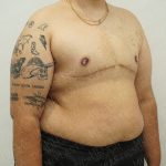 Chest Masculinization Surgery Before & After Patient #4224