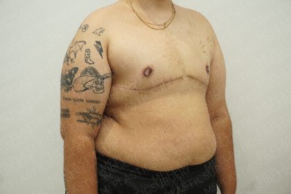 Chest Masculinization Surgery Before & After Patient #4224