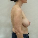 Breast Reduction Before & After Patient #4181
