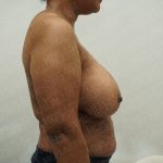Breast Reduction Before & After Patient #4183