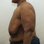 Breast Reduction Before & After Patient #4184