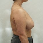 Breast Reduction Before & After Patient #4185