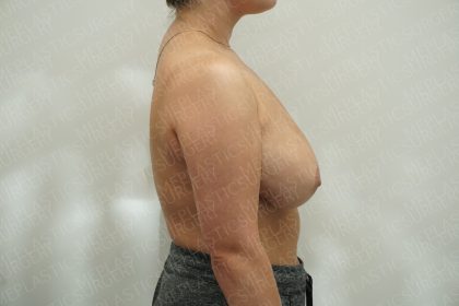 Breast Reduction Before & After Patient #4185