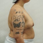 Chest Masculinization Surgery Before & After Patient #4224