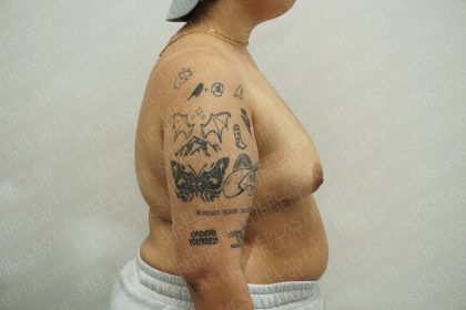 Chest Masculinization Surgery Before & After Patient #4224