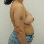 Breast Reduction Before & After Patient #4182