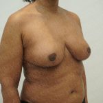 Breast Reduction Before & After Patient #4183