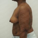 Breast Reduction Before & After Patient #4184