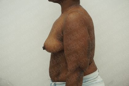 Breast Reduction Before & After Patient #4184