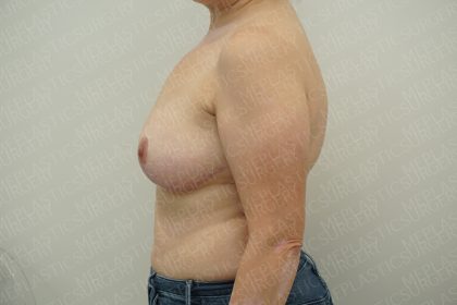 Breast Reduction Before & After Patient #4186