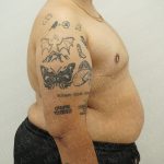 Chest Masculinization Surgery Before & After Patient #4224