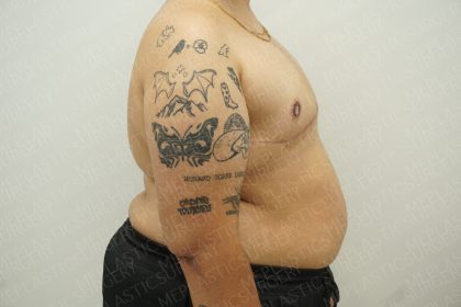 Chest Masculinization Surgery Before & After Patient #4224