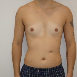 Chest Masculinization Surgery Before & After Patient #4235