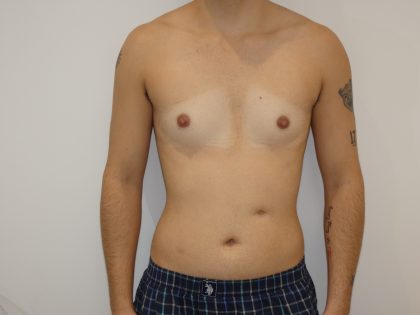 Chest Masculinization Surgery Before & After Patient #4235