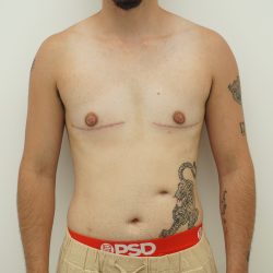 Chest Masculinization Surgery Before & After Patient #4235