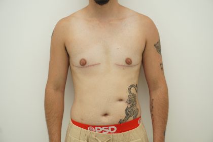 Chest Masculinization Surgery Before & After Patient #4235