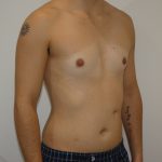 Chest Masculinization Surgery Before & After Patient #4235