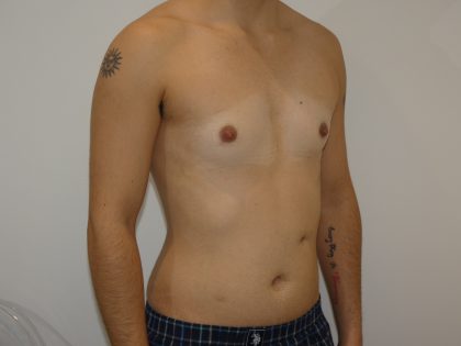 Chest Masculinization Surgery Before & After Patient #4235