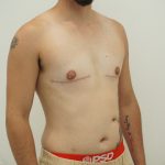 Chest Masculinization Surgery Before & After Patient #4235
