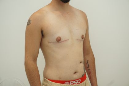 Chest Masculinization Surgery Before & After Patient #4235