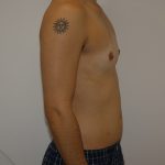 Chest Masculinization Surgery Before & After Patient #4235