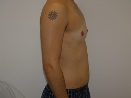 Chest Masculinization Surgery Before & After Patient #4235