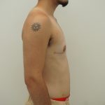 Chest Masculinization Surgery Before & After Patient #4235