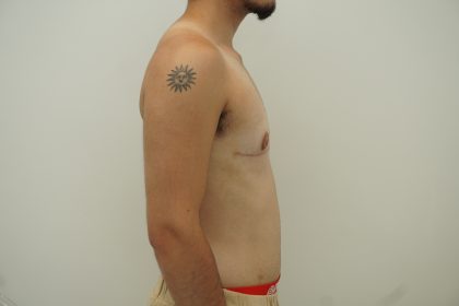 Chest Masculinization Surgery Before & After Patient #4235
